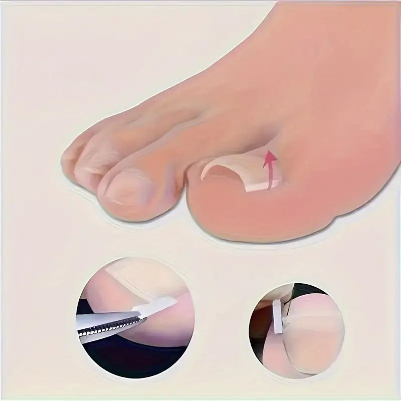 Correcteur d’Ongles Incarnés en Silicone – Clip Redresseur Indolore pour Soulager la Douleur et Corriger la Courbure des Ongles