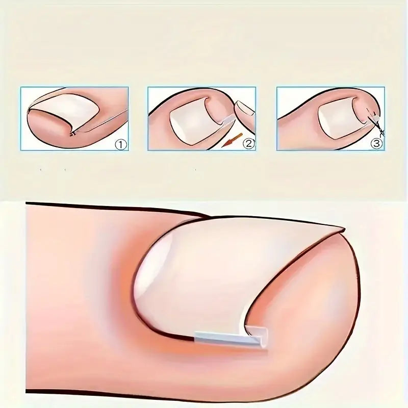 Correcteur d’Ongles Incarnés en Silicone – Clip Redresseur Indolore pour Soulager la Douleur et Corriger la Courbure des Ongles