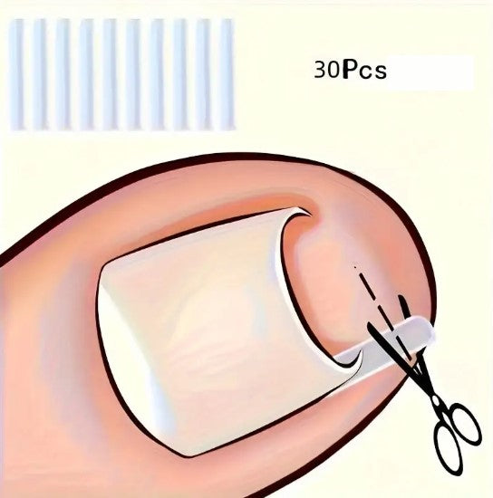 Correcteur d’Ongles Incarnés en Silicone – Clip Redresseur Indolore pour Soulager la Douleur et Corriger la Courbure des Ongles