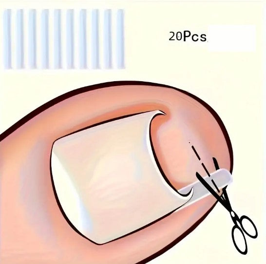 Correcteur d’Ongles Incarnés en Silicone – Clip Redresseur Indolore pour Soulager la Douleur et Corriger la Courbure des Ongles