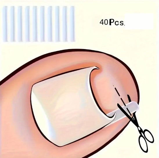 Correcteur d’Ongles Incarnés en Silicone – Clip Redresseur Indolore pour Soulager la Douleur et Corriger la Courbure des Ongles