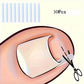 Correcteur d’Ongles Incarnés en Silicone